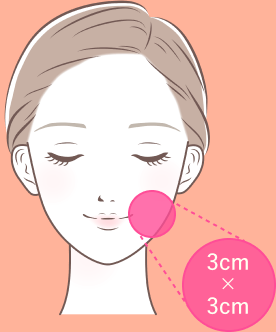 縦3cm×横3cmのスポット治療範囲のイメージ
