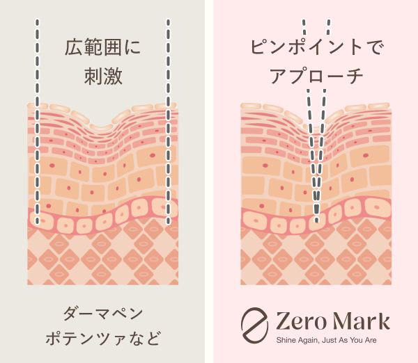 広範囲刺激とピンポイントアプローチの比較図