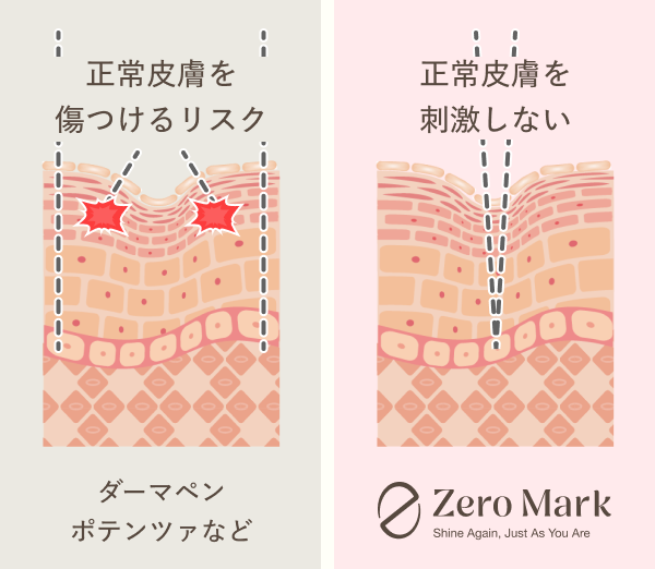 正常皮膚への刺激リスクの比較図